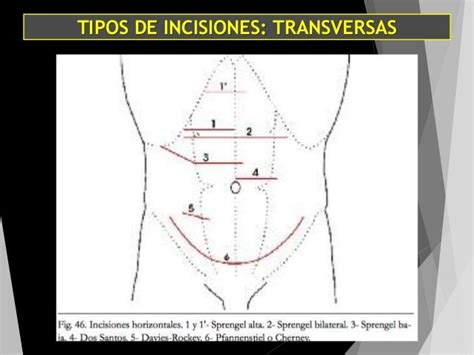 Abdomen E Insiciones Quirugicas