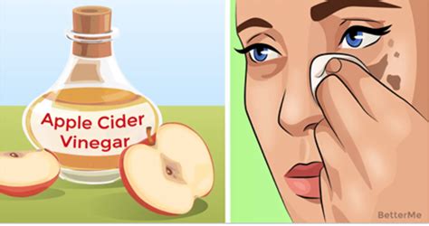 6 Amazing Ways To Improve Skin With Apple Cider Vinegar Apple Cider Vinegar Cider Cider Vinegar