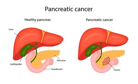 Pancreatic Cancer