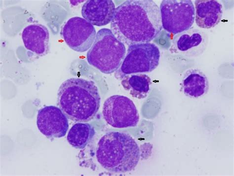 Chronic Eosinophilic Leukaemia Cel