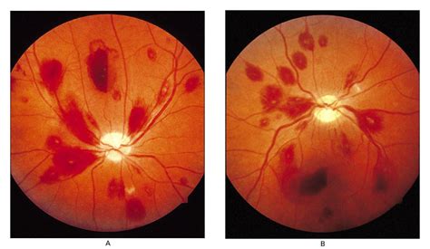 Retinopathy Ischemic Retinopathy