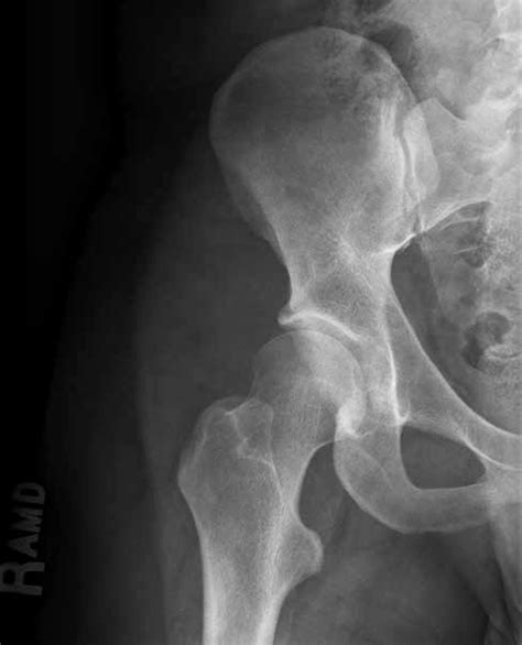 Ap Radiograph Of The Right Hip Demonstrating Coxa Valga And A Femoral