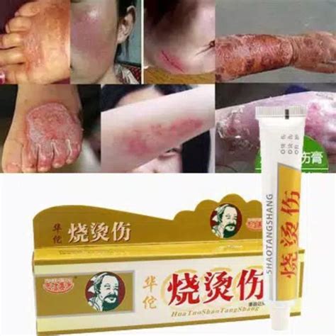 Jual Salep Huatuo Shao Tangshang Obat Cina Herbal Luka Bakar Melepuh