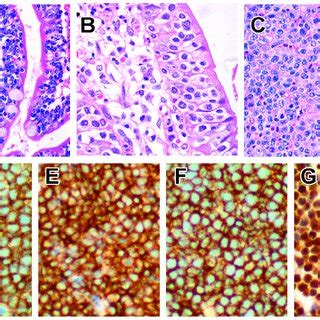 Monomorphic Epitheliotropic Intestinal T Cell Lymphoma MEITL A Case