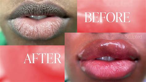 Lip Neutralization What You Need To Know