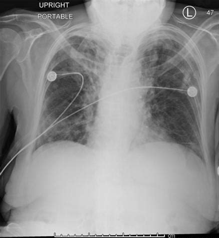 Portable Chest X Ray Performed 3 Months After Her Presentation With