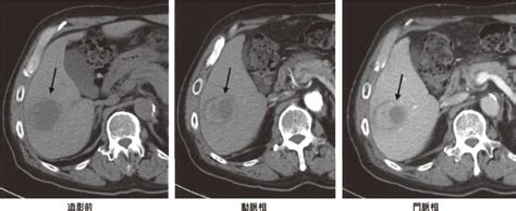 癌 Ct検査 造影剤 Hello Doctor