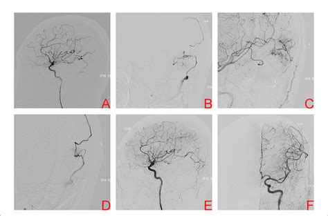 Figure Digital Subtraction Angiography Of Left Internal Carotid Artery