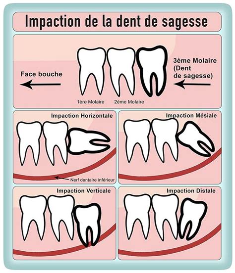 Extraction De Dents De Sagesse