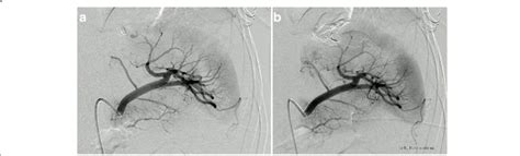 Selective Catheter Angiography From An Upper Pole Splenic Artery Download Scientific Diagram