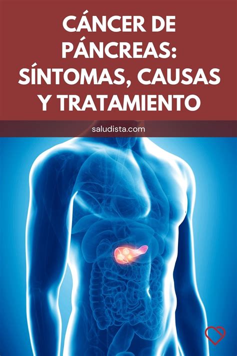 Cáncer de páncreas Síntomas causas y tratamiento