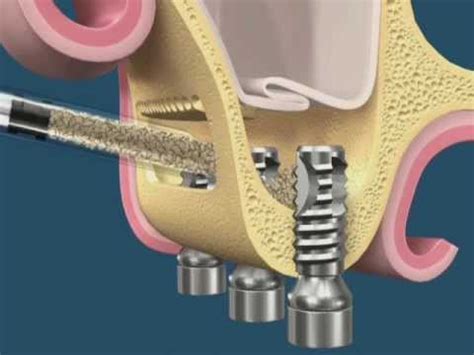 Levantamento De Seio Maxilar Implante Imediato YouTube