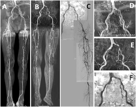 Evaluation Of Quiescent Interval Single Shot Magnetic Resonance Angiography In Diabetic Patients