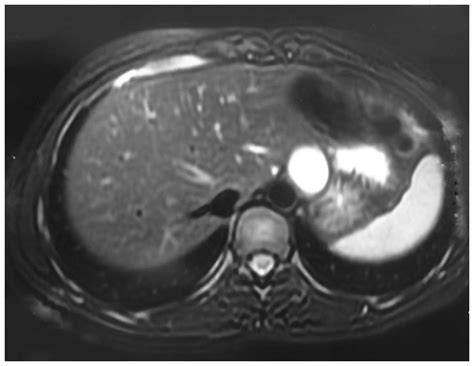 Gastric Bronchogenic Cysts A Case Report And Literature Review