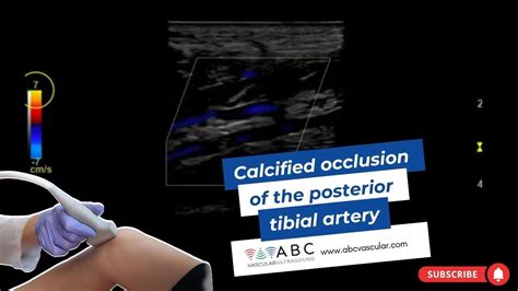 Calcified occlusion of the posterior tibial artery: tips for ultrasound operators - YouTube