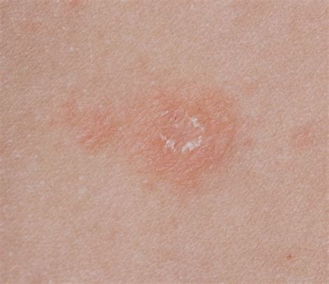 Pityriasis Rosea West Houston Dermatology