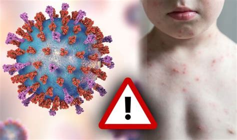 Europe Holiday Warning Measles Mumps Rubella Fears Britons Urged