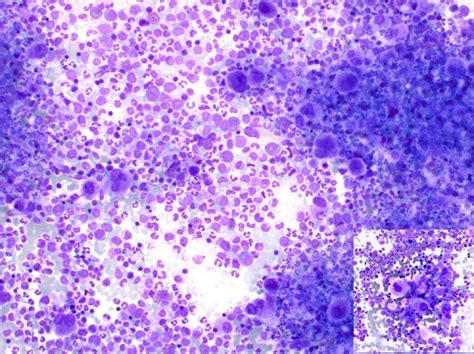 Leucemia Mieloide Cr Nica Bcr Abl