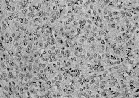 A Case Of Poorly Differentiated Sertoli Leydig Tumor Of The Ovary