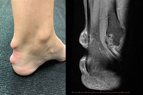 Rheumatoid Arthritis In The Ankle