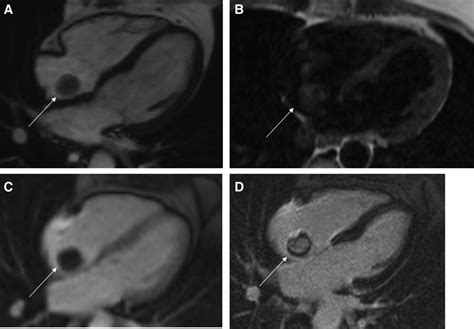 Atrial Septal Defect Mimicking Right Atrial Myxoma Circulation