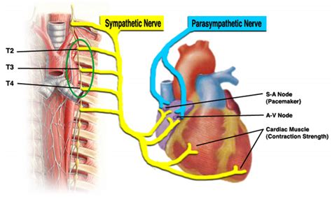 Corposcindosis: Heart