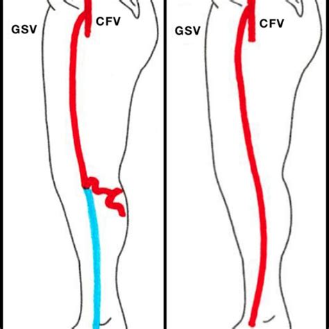 Measurement Sites Of The Great Saphenous Vein A And Small Saphenous