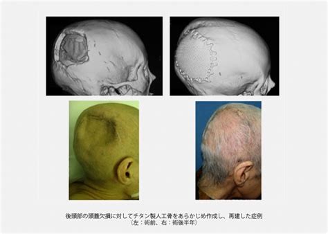 頭蓋骨・顔面骨の変形｜診療のご案内｜琉球大学病院 形成外科