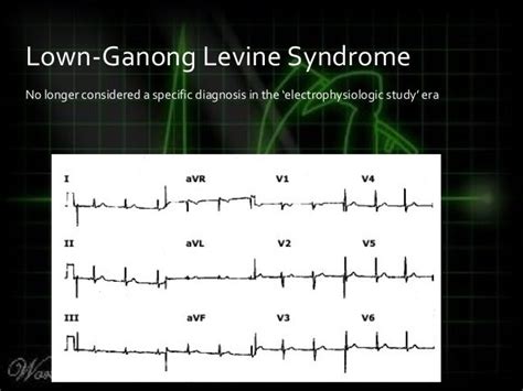 Killer Ecgs