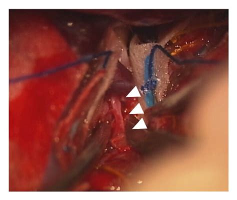 Images Of The Initial Procedure A Photograph Showing A Huge Subdural