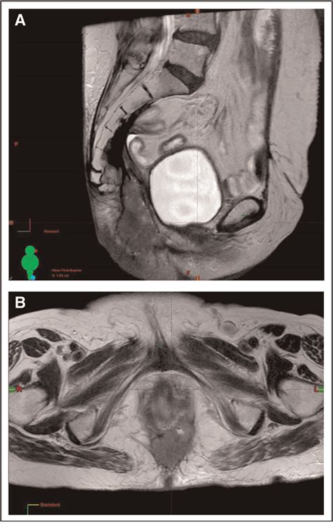 A Sagittal T2 Weighted Magnetic Resonance Image Of The Pelvis Showing