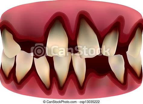 Picture Of Tooth Tihs Is A Picture Of Very Bad Tooth Canstock