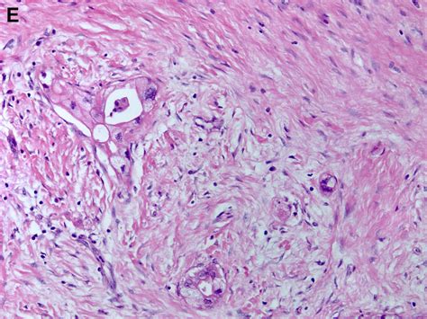 The Histopathology Of Neoadjuvant Treated Nat Pancreatic Ductal