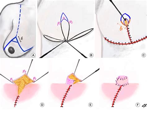 Figure 1 From Optimizing Aesthetic Outcomes After Goldilocks Mastectomy