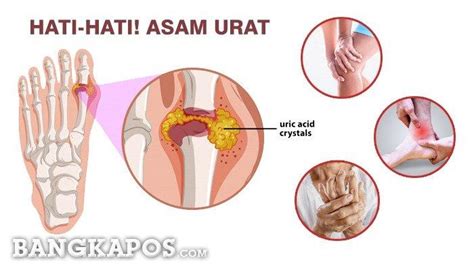 Mengenal Obat Asam Urat Allopurinol Obati Rasa Nyeri Hebat Pada Sendi