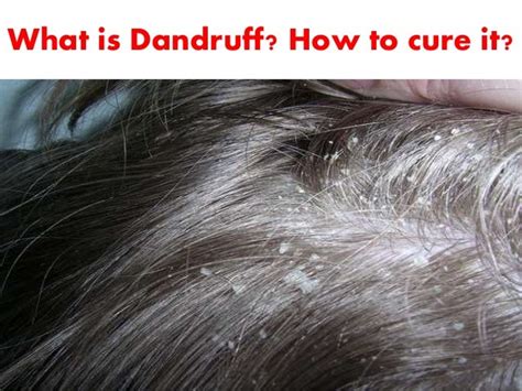 What Is Dandruff