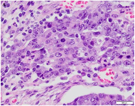 Cellular Localization Of Pd L Expression In Mismatch Repair Deficient