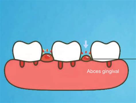 Abcesul Dentar Cauze Si Tratamentul Corect Clinica SyroDent