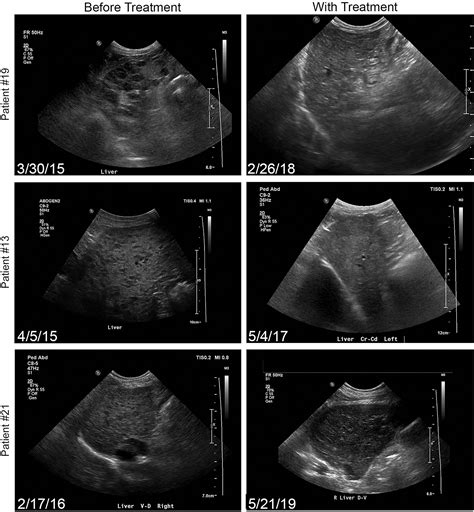 Treatment And Outcomes Of Dogs With Hepatocutaneous Syndrome Or