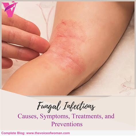 Fungal Infections Causes Symptoms Treatments And Preventions Artofit