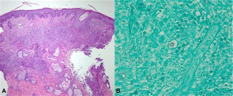 Paracoccidioidomycosis: An atypical presentation in an immunocompetent ... 