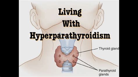 Living With Hyperparathyroidism Hypercalcemia Too Much Calcium