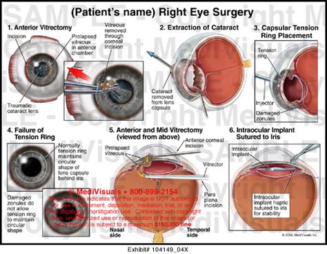 Vitrectomy Cataract Removal And Intraocular Implant Placement