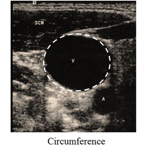 Ultrasonographic Image Showing Ijv Circumference And Csa Scm Download Scientific Diagram