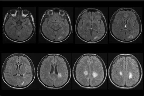 Rm T Flair Con Lesiones Hiperintensas De La Sustancia Blanca Profunda