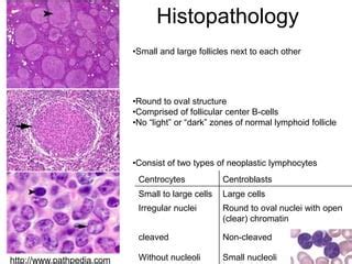 follicular lymphoma PPT无注释.ppt