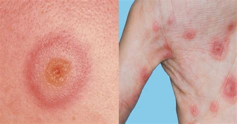 What Is Erythema Multiform Teroes