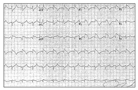 Pulmonary Embolism Mimicking Anteroseptal Acute Myocardial Infarction