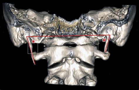 Transoral Removal Of Elongated Styloid Process Clinical Tree