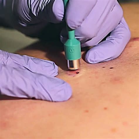 Skin Biopsy Dr Wang Yi Shi W Skin And Laser Clinic